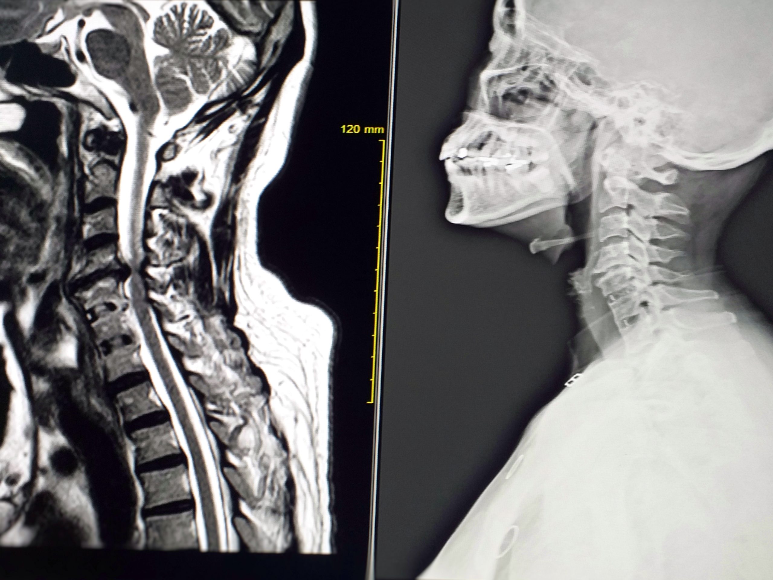 Unveiling Rarity: Horner Syndrome Caused by Cervical Disc Herniation ...